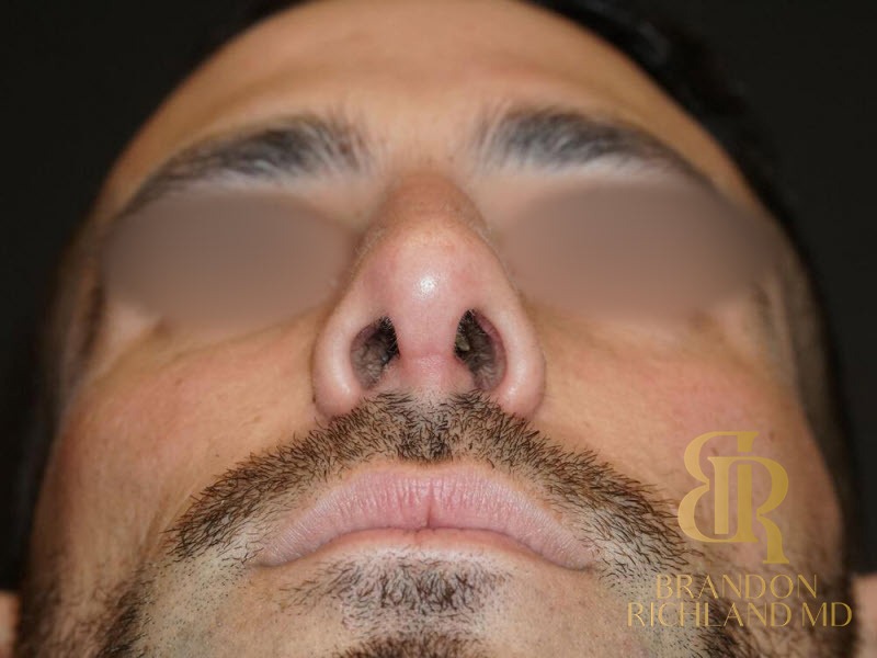 Rhinoplasty After photo, Patient 01