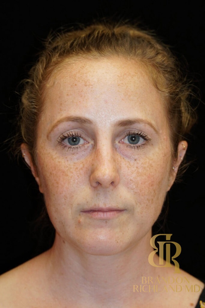 Rhinoplasty Before photo, Patient 02