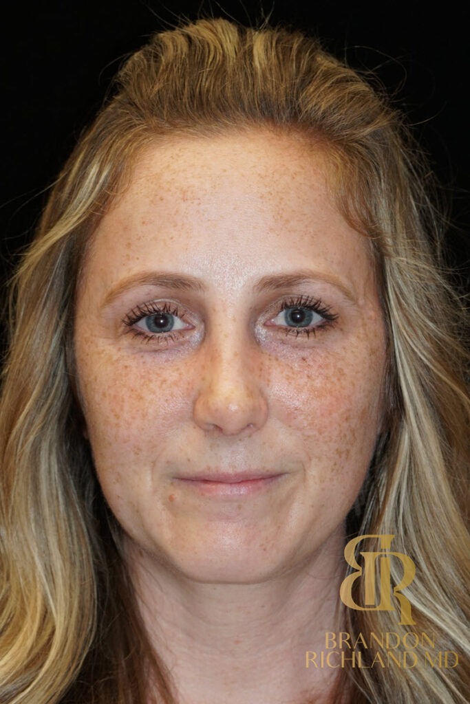 Rhinoplasty After photo, Patient 02