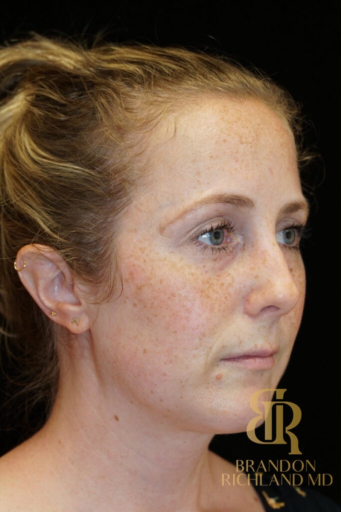 Rhinoplasty Before photo, Patient 02