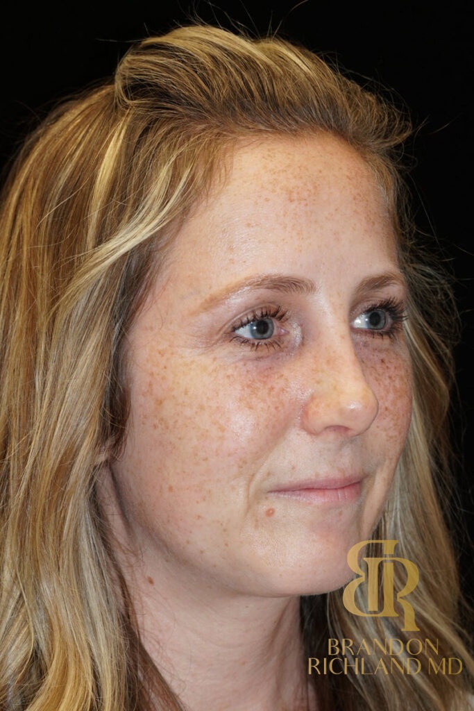 Rhinoplasty After photo, Patient 02