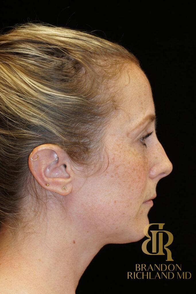 Rhinoplasty Before photo, Patient 02