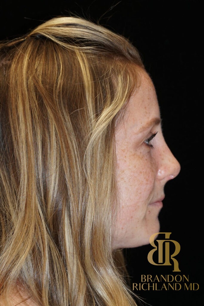 Rhinoplasty After photo, Patient 02