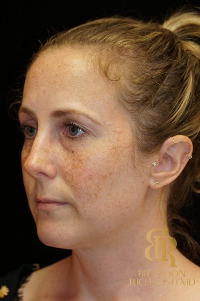 Rhinoplasty Before photo, Patient 02