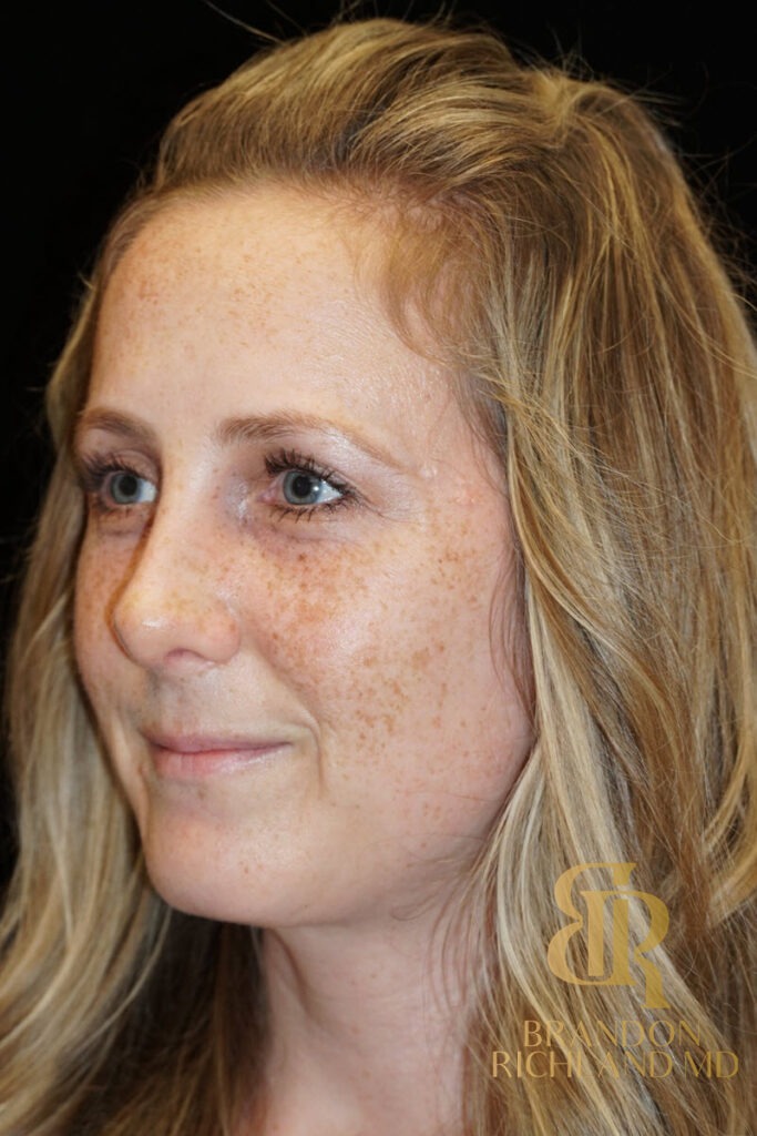 Rhinoplasty After photo, Patient 02