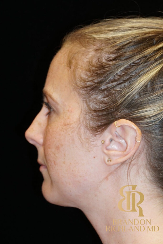 Rhinoplasty Before photo, Patient 02