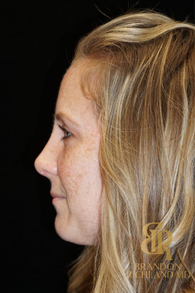 Rhinoplasty After photo, Patient 02