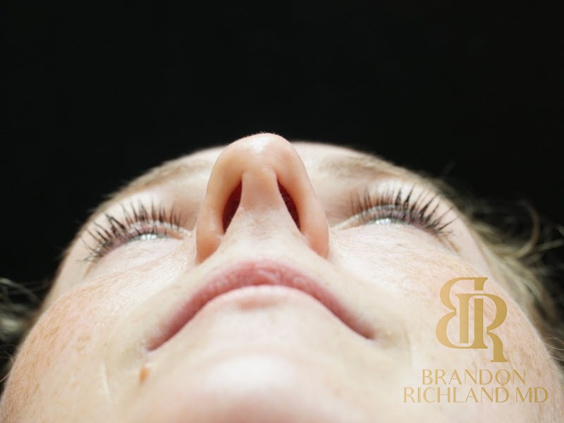 Rhinoplasty Before photo, Patient 02