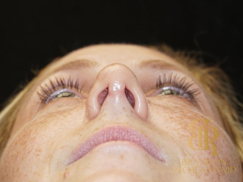 Rhinoplasty After photo, Patient 02