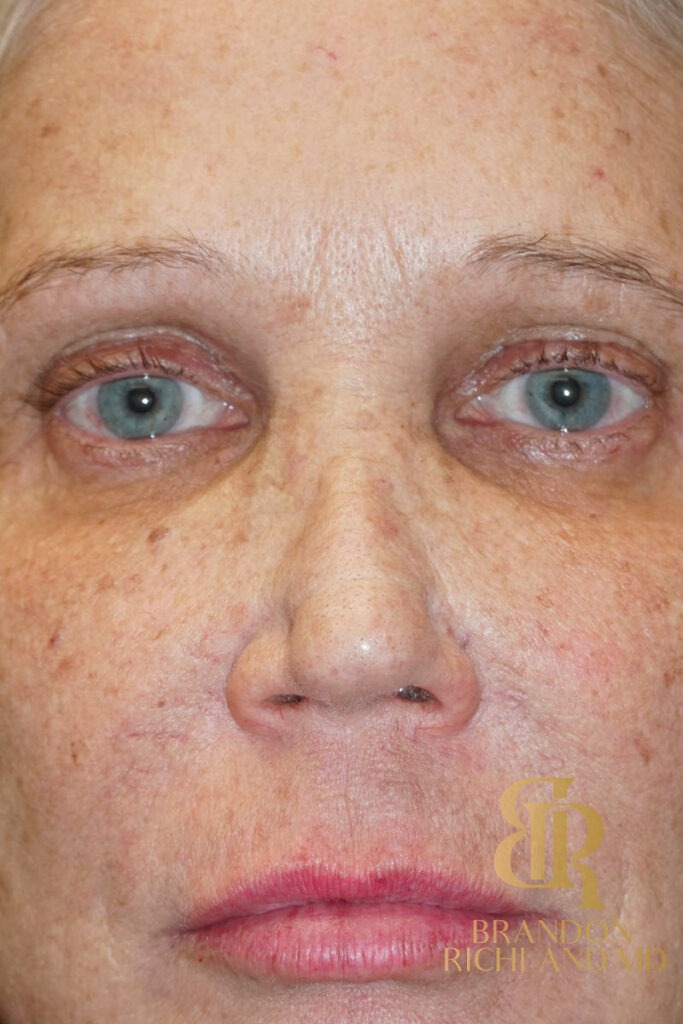 Rhinoplasty Before photo, Patient 03