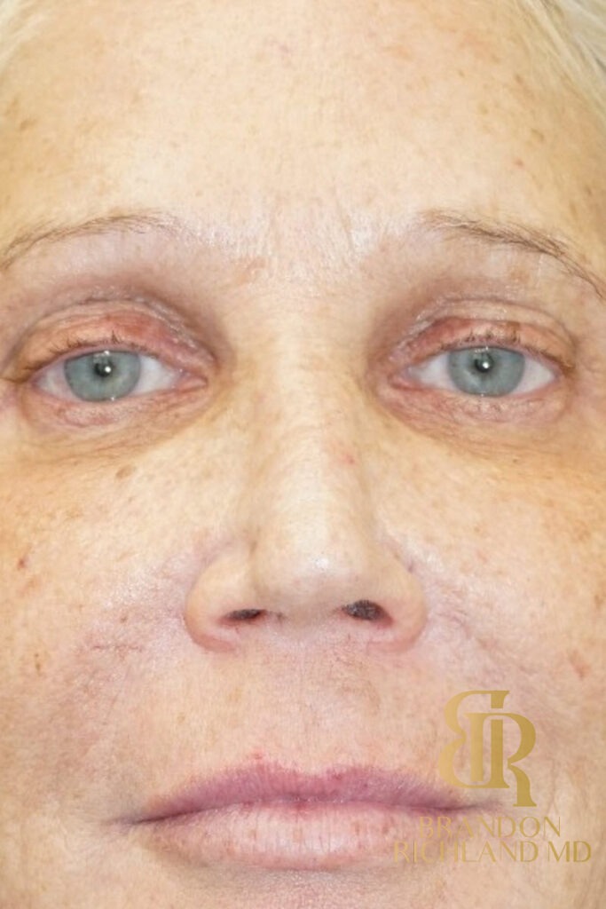 Rhinoplasty After photo, Patient 03